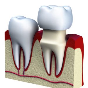 eugene dental crown