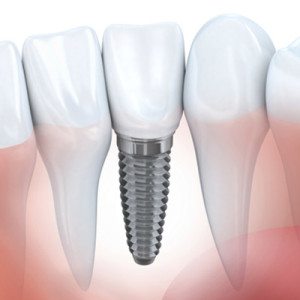 Dental implants Eugene