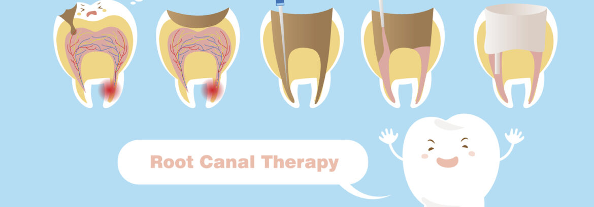 6 Reasons Why You Might Need a Root Canal